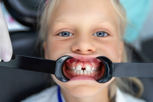 Silver Diamine Fluoride (SDF) at Chatham Pediatric Dentistry